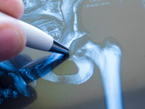 How to Prepare Seniors for Hip Replacement Surgery