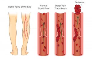 What Is Deep Vein Thrombosis