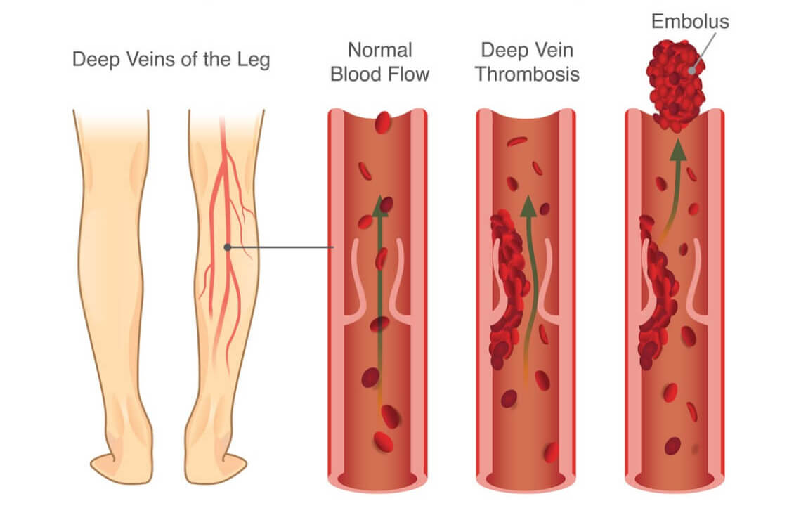 What Is Deep Vein Thrombosis