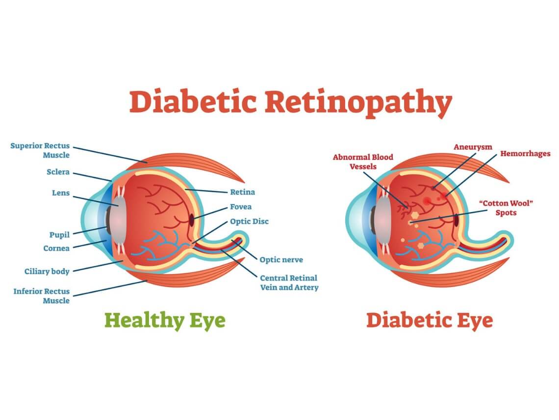 what is diabetic retinopathy